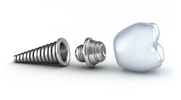 parts of a dental implant