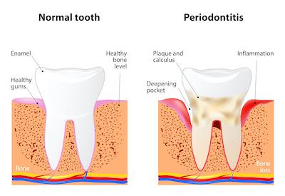 normal tooth on left and tooth with periodontitis on the right