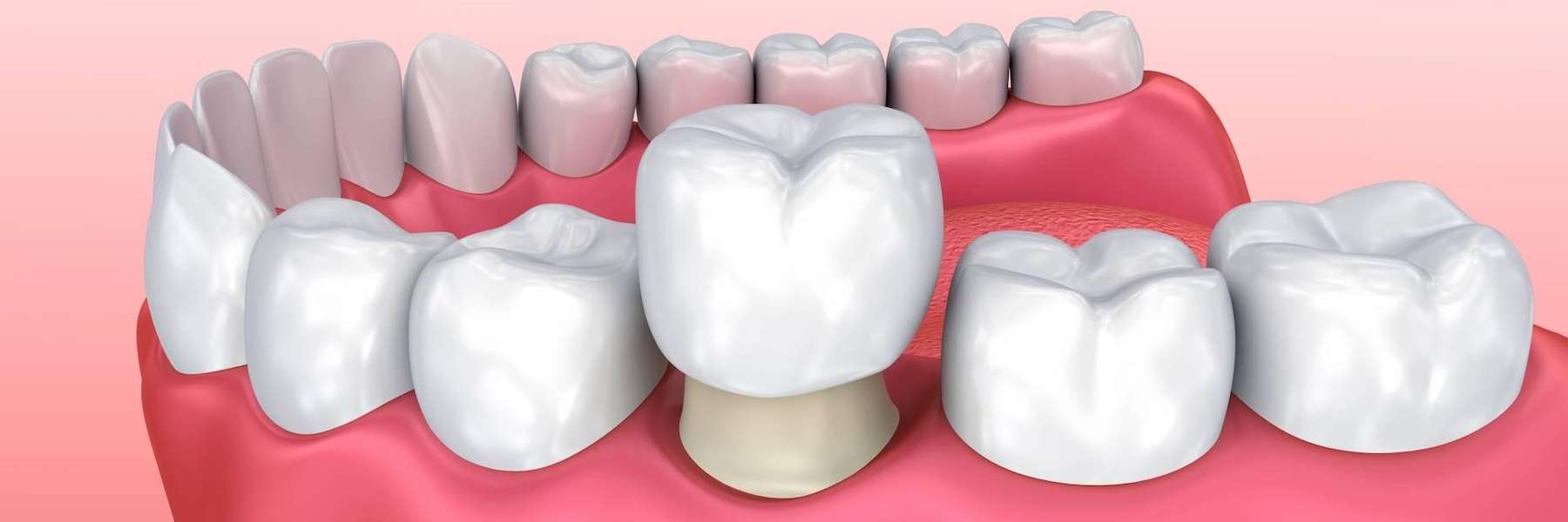 Dental crowns in Palatine IL