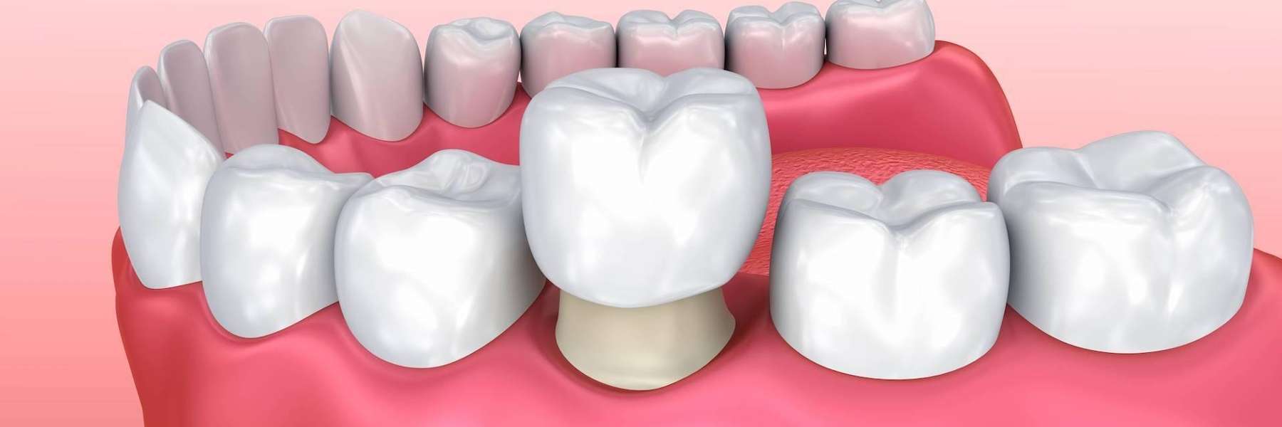 tooth crown