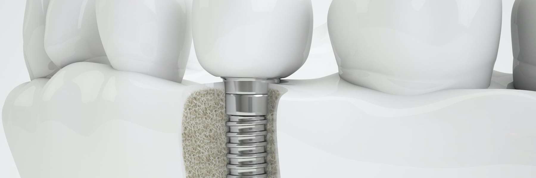 Diagram of a successful dental implant in the jawbone. Palatine, IL