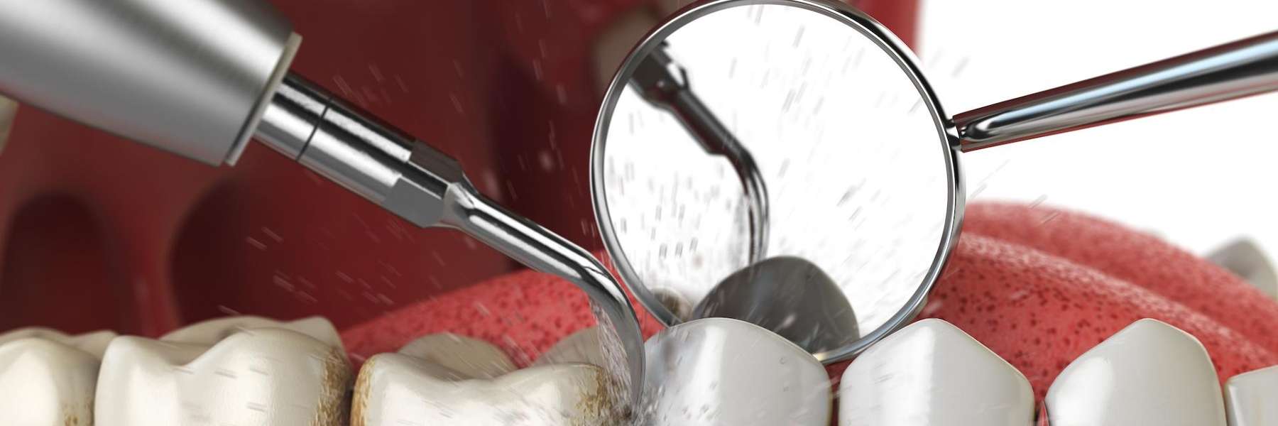dental tools working on teeth to treat gum disease