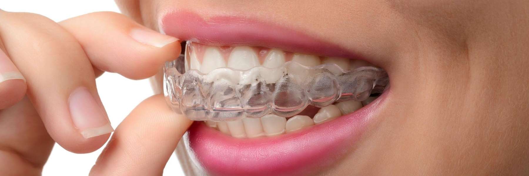 close up of palatine woman using Invisalign 
