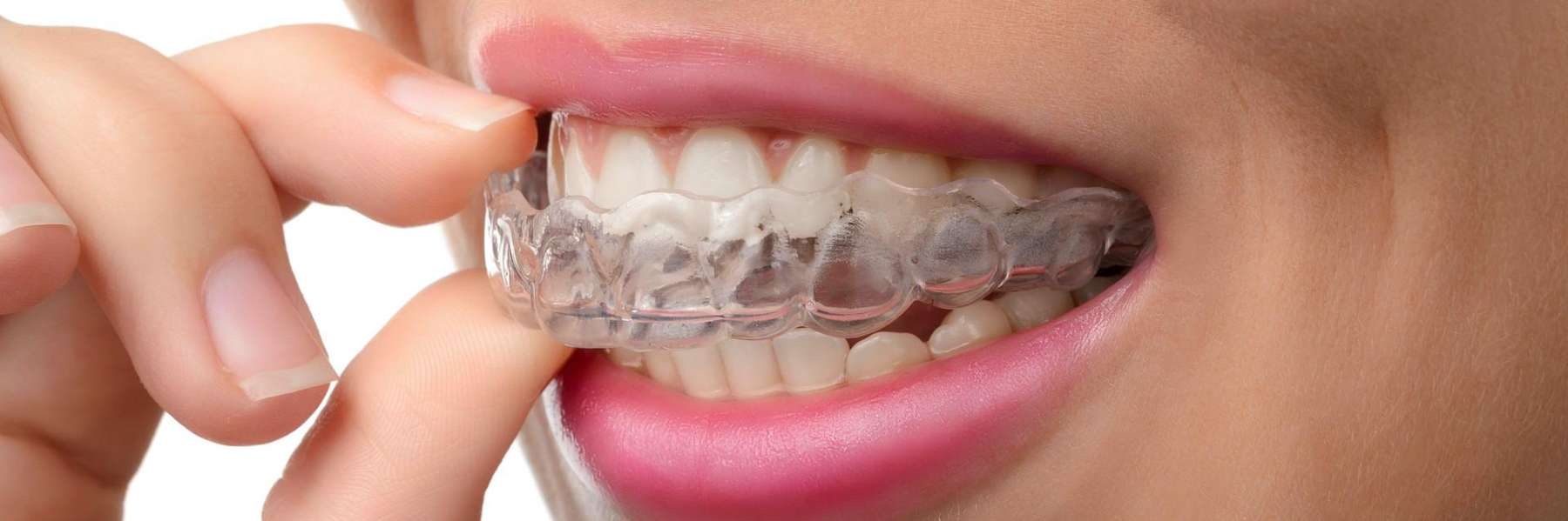 Invisalign out of tray