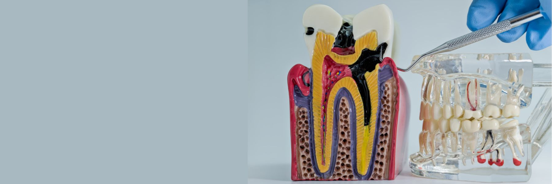 Root Canal Therapy | Dentist