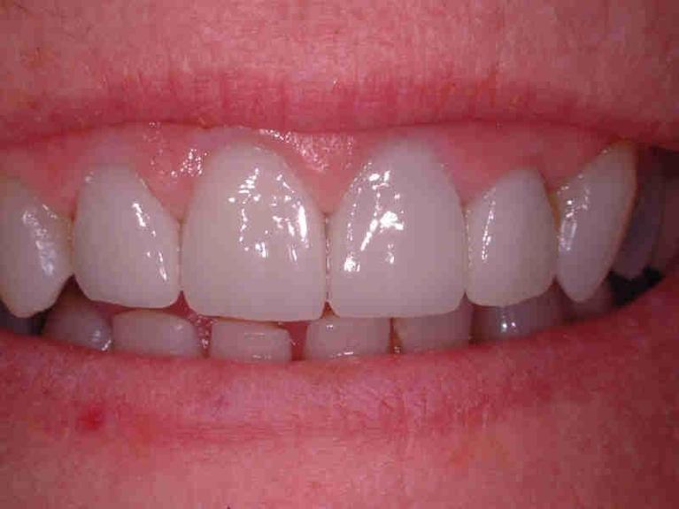 All-Ceramic-Crowns-After-Image