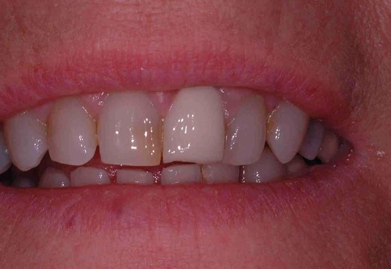 All-Ceramic-Crowns-Before-Image