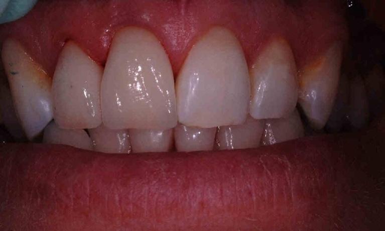 close up of patient's smile after cosmetic dentistry