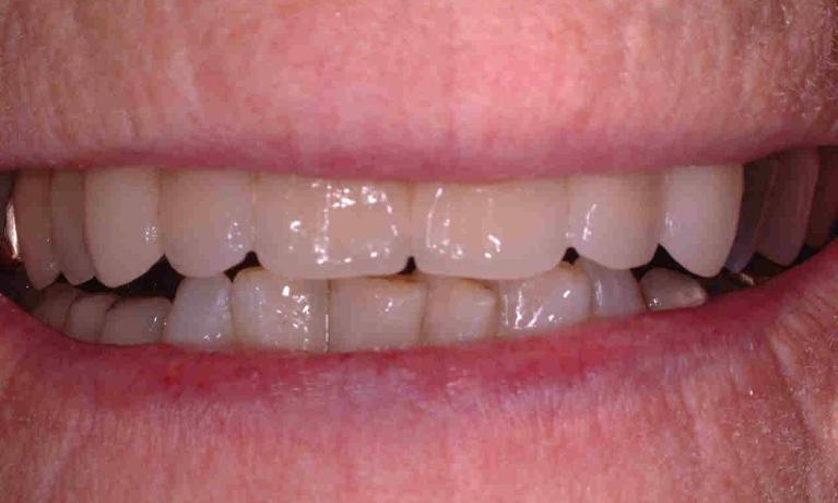 patient's white and straight smile after dental work