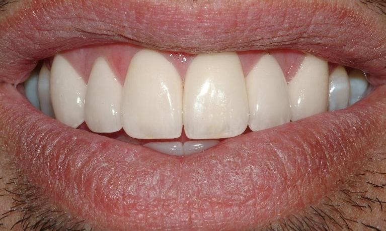 patient's smile after straightening front teeth
