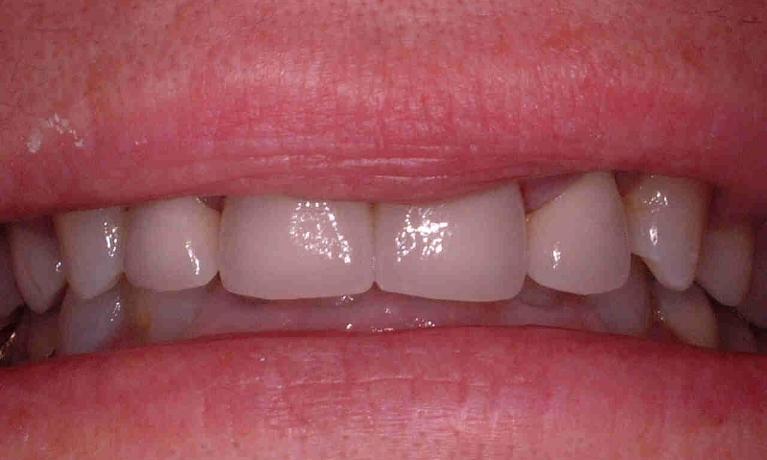 Old-Fillings-Replaced-After-Image