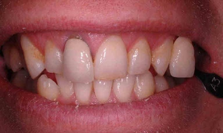 close up of patient's smile before cosmetic dentistry