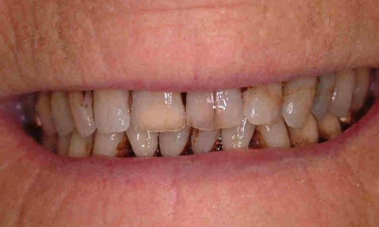 patient's teeth are worn and discolored