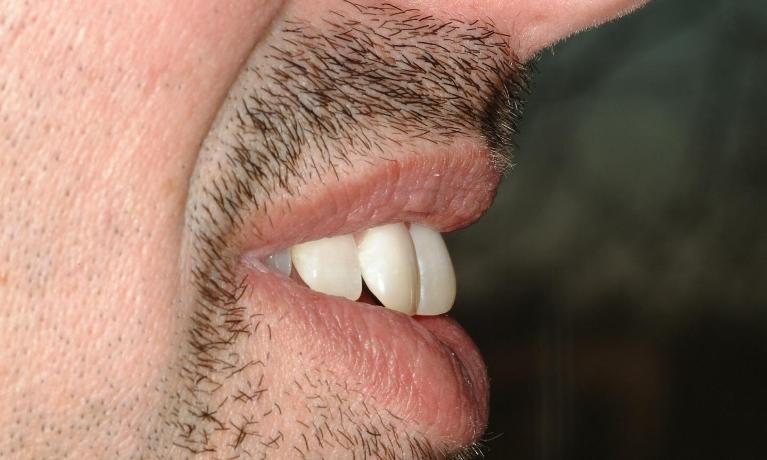 profile of patient's smile showing front teeth bending in