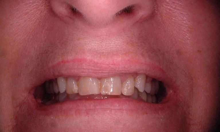 Old-Fillings-Replaced-Before-Image